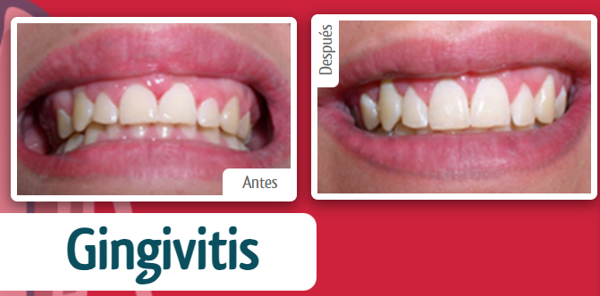 gingivitis