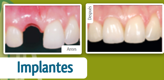 implantes