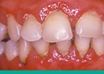 periodontitis