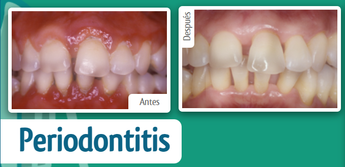 periodontitis